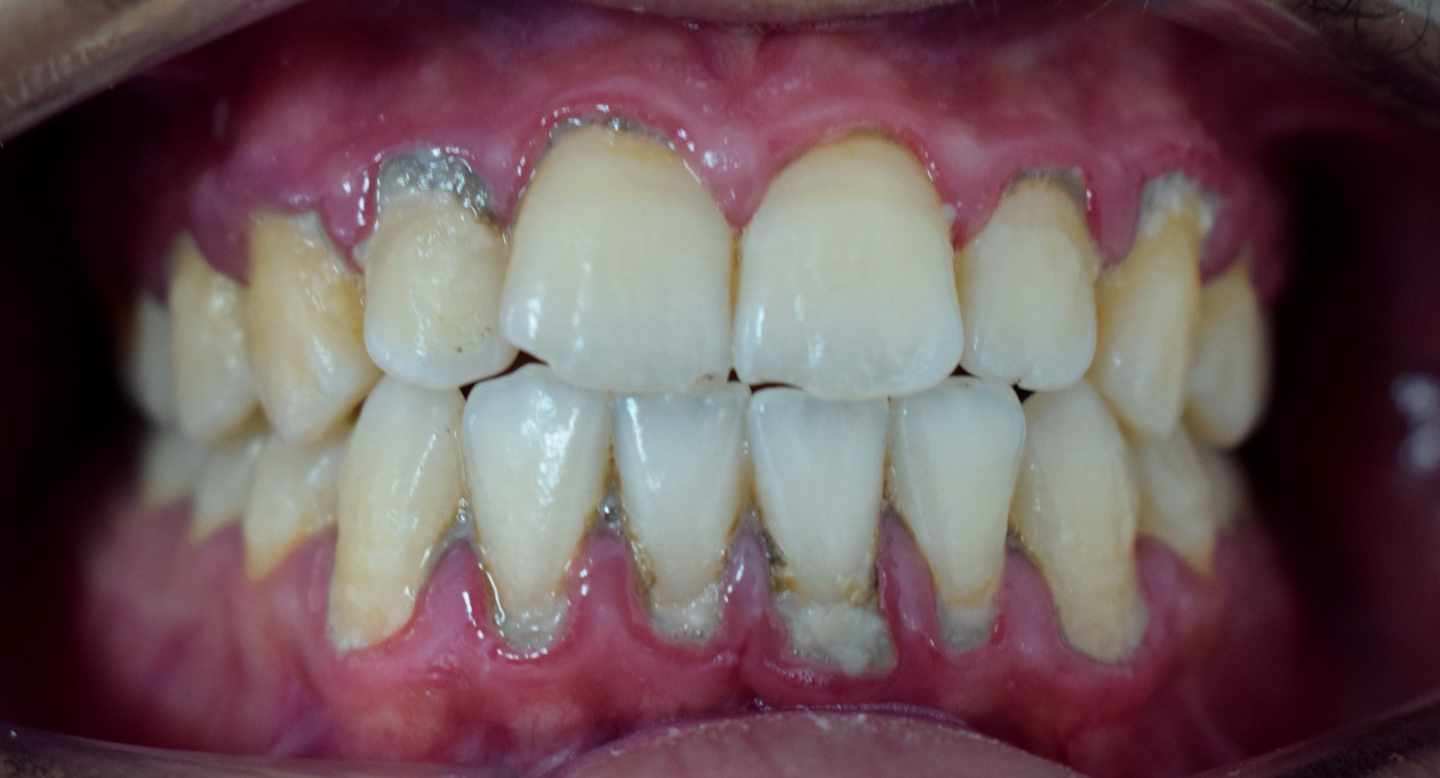 <p>Periodontitis
