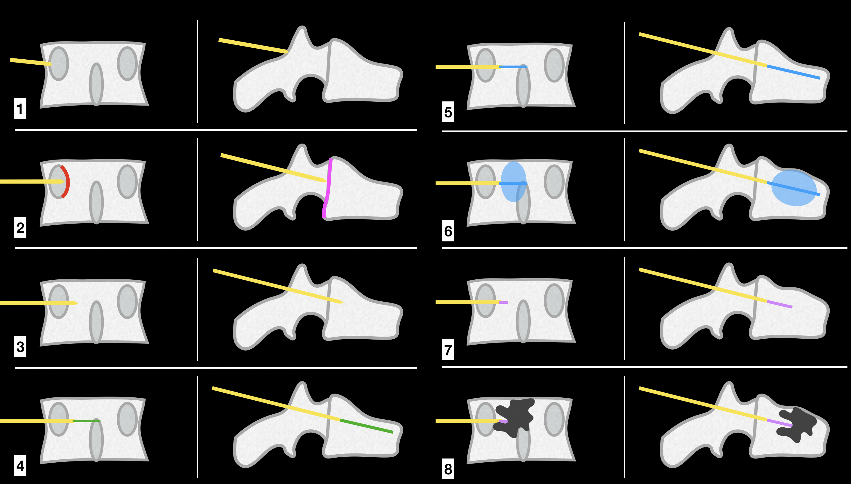 <p>Typical Procedural Steps for Percutaneous Vertebroplasty and Kyphoplasty