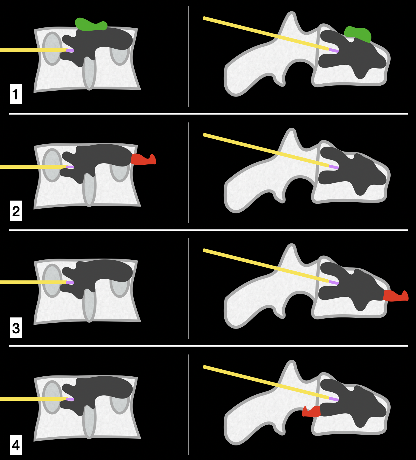 <p>Cement Leakage Complications in Vertebroplasty and Kyphoplasty