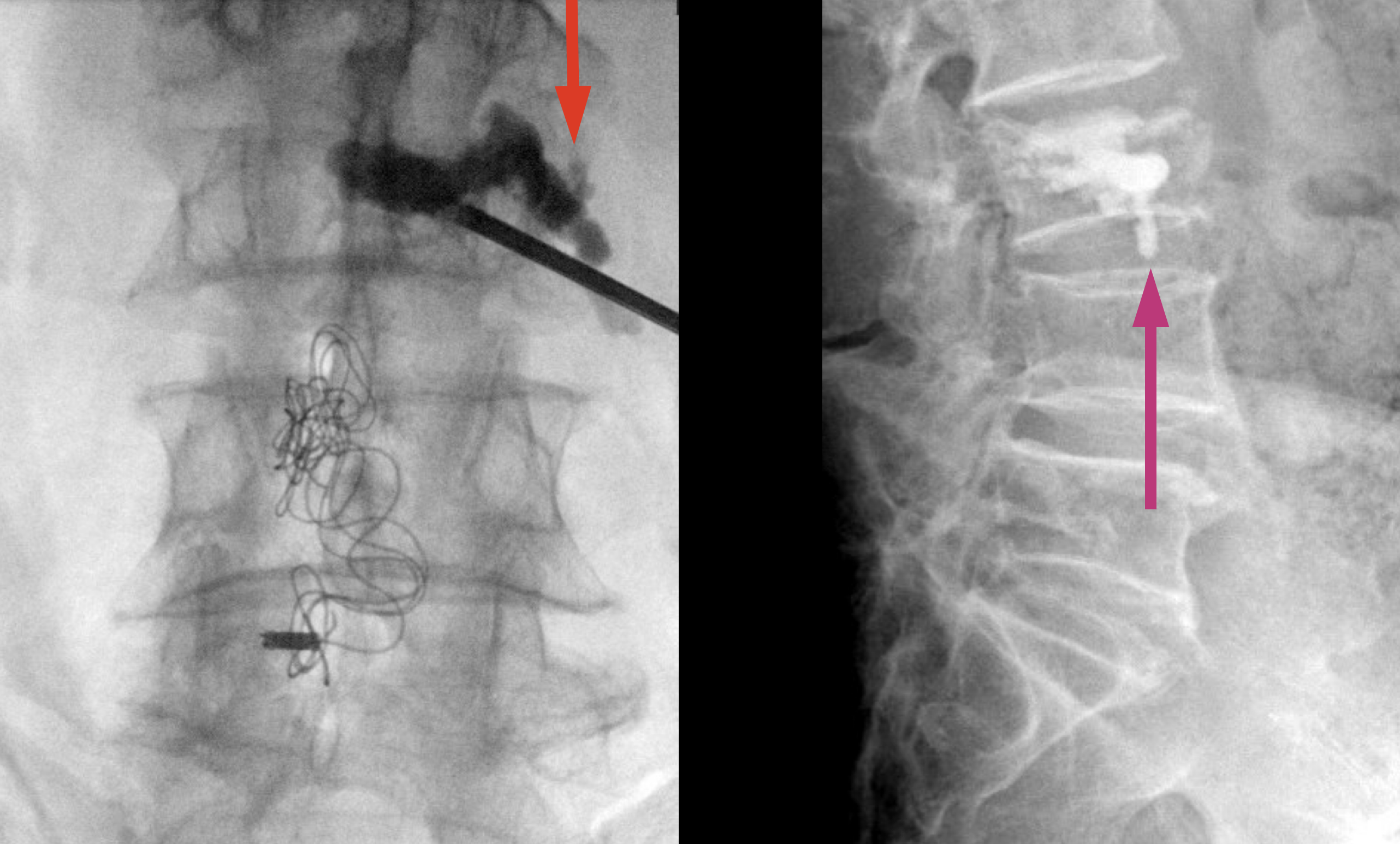 <p>Bone Cement Leakage in Vertebroplasty and Kyphoplasty