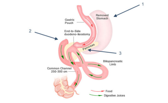 <p>Single Anastomosis Duodenal-Ileal Bypass With Sleeve Gastrectomy (SADI-S)
