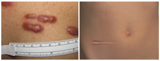 <p>Keloid&nbsp;Scars.</p>