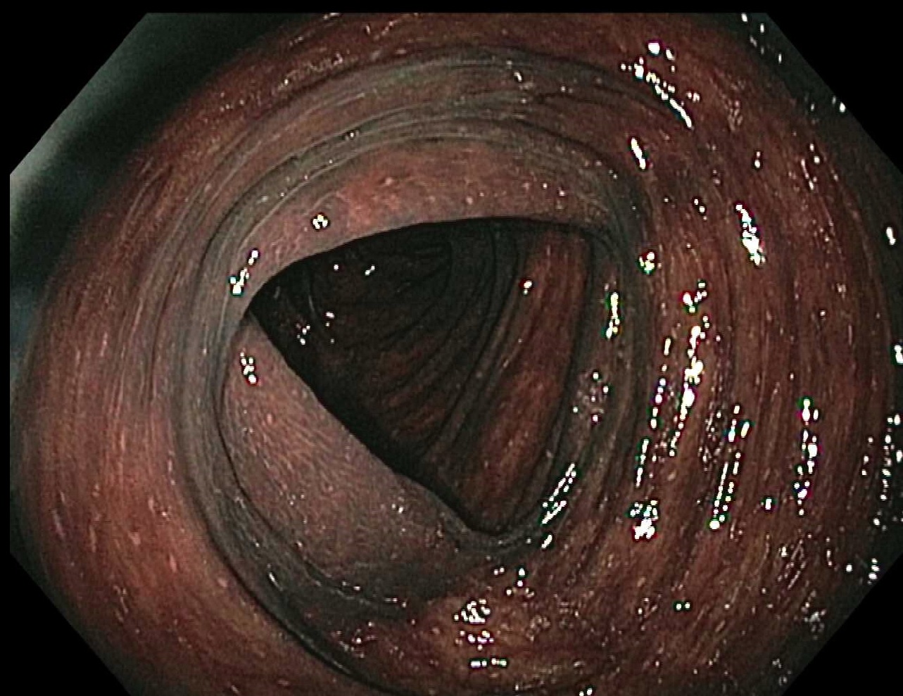 <p>Melanosis Coli. Image demonstrating the dark brown appearance of the colonic mucosa in melanosis coli.</p>