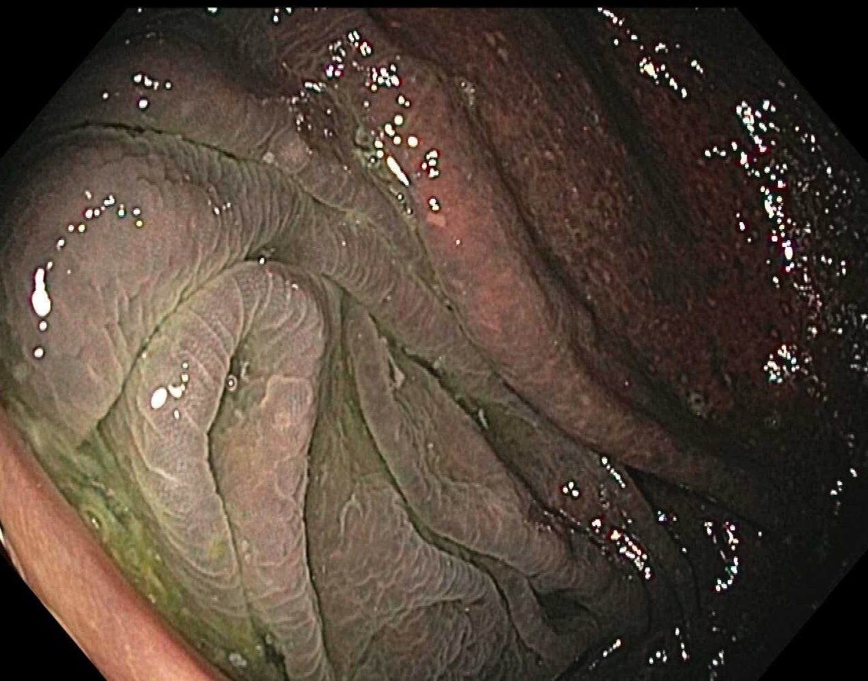 <p>Proximal Colon With Melanosis Coli