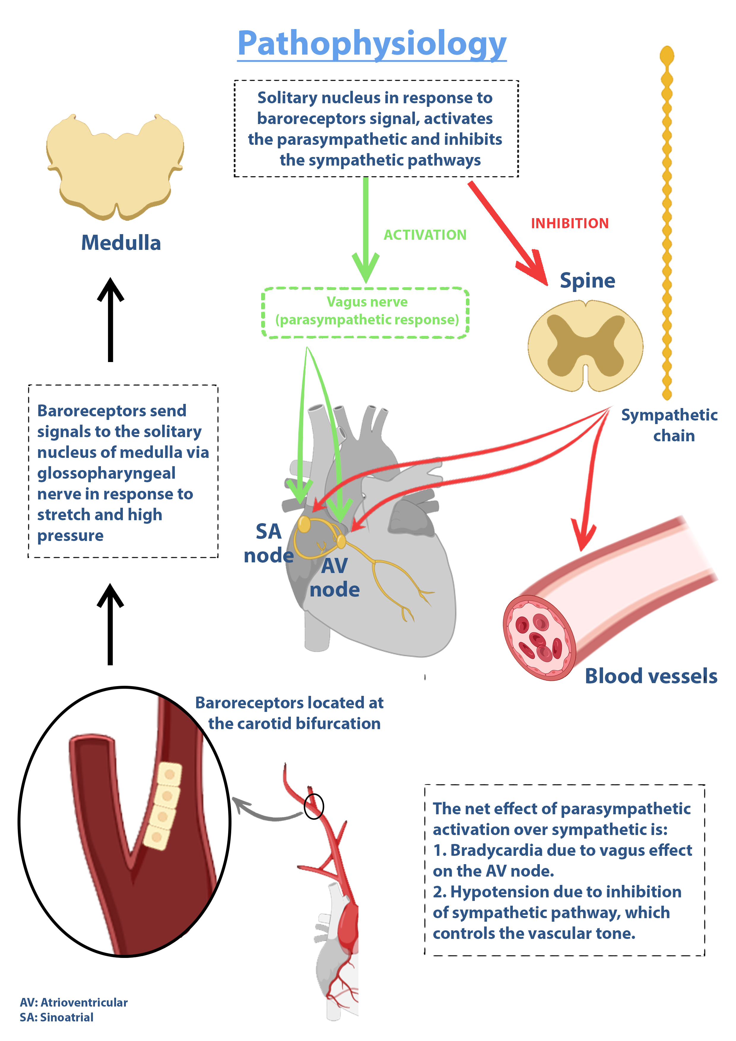 <p>Pathophysiology of Carotid Sinus Hypersensitivity