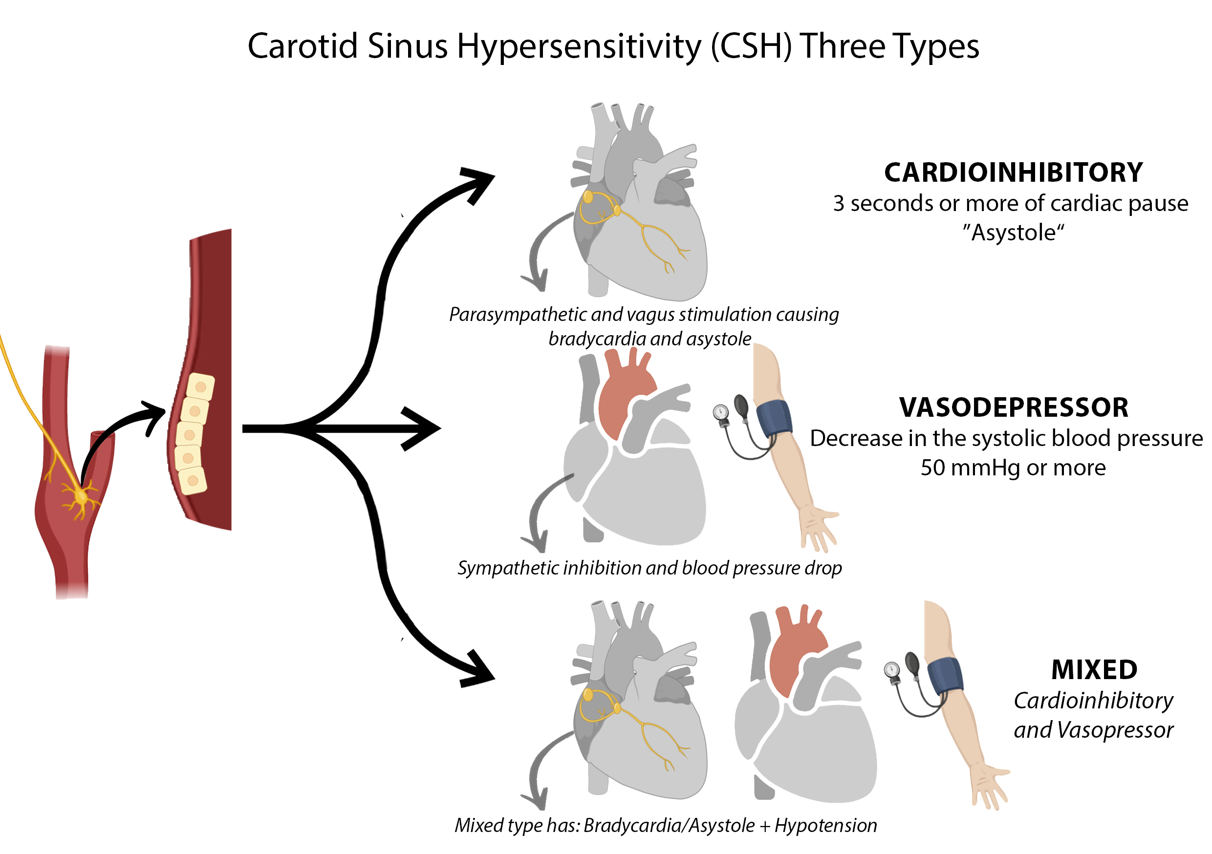 <p>Types of Carotid Sinus Hypersensitivity
