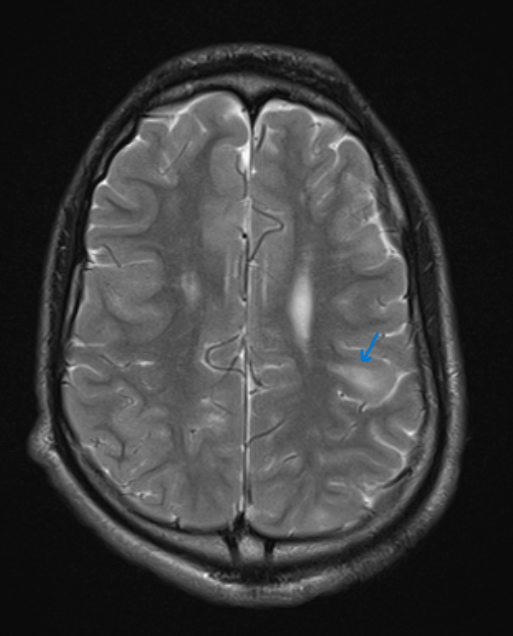<p>Tuberous Sclerosis, T2-Weighted Brain Magnetic Resonance Image (MRI)