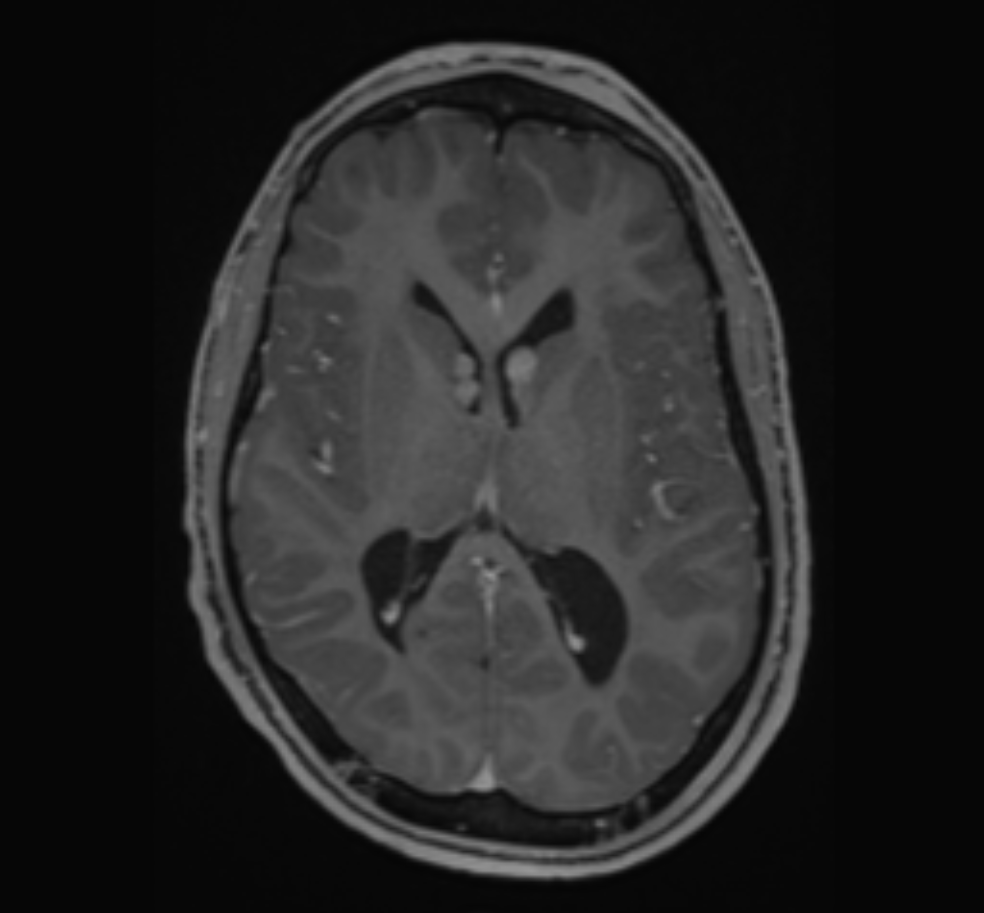 <p>Tuberous Sclerosis, T1-Weighted Brain Magnetic Resonance Image (MRI)