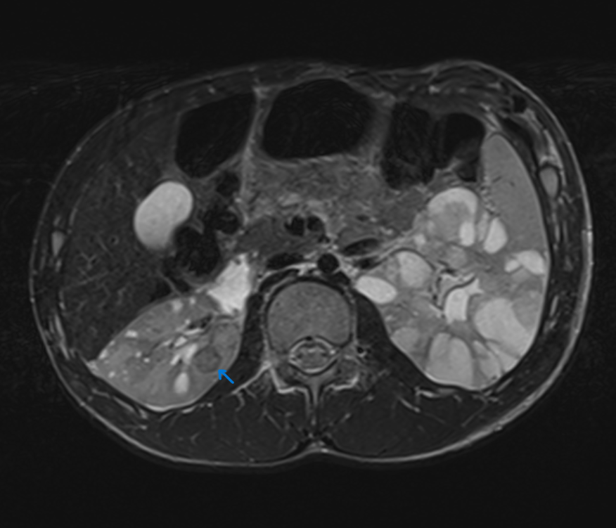 <p>Tuberous Sclerosis, Abdominal Magnetic Resonance Image (MRI)