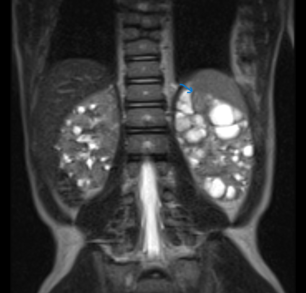 <p>Tuberous Sclerosis, T2-weighted Abdominal Magnetic Resonance Image (MRI)