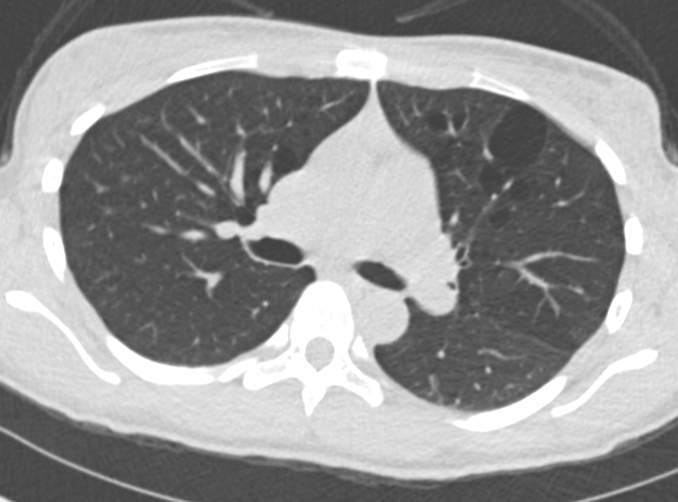 <p>Tuberous Sclerosis, Chest Computed Tomography (CT)
