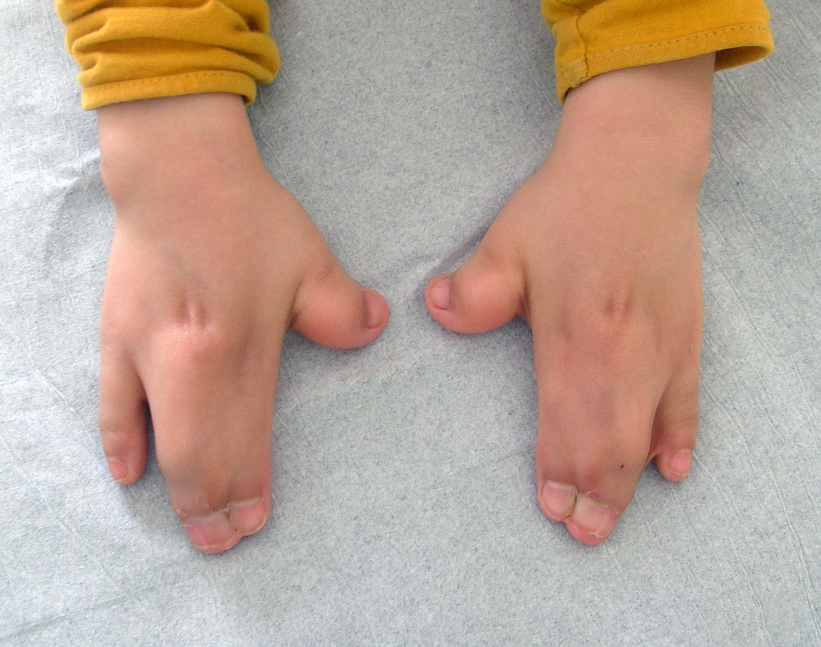 <p>Hand Findings in Apert Syndrome