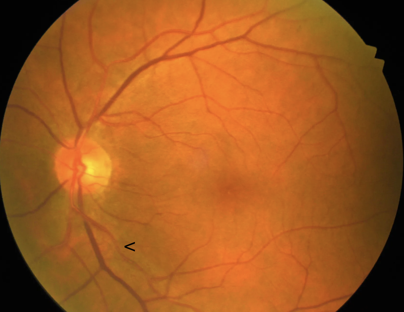 <p>Focal Arteriolar Narrowing