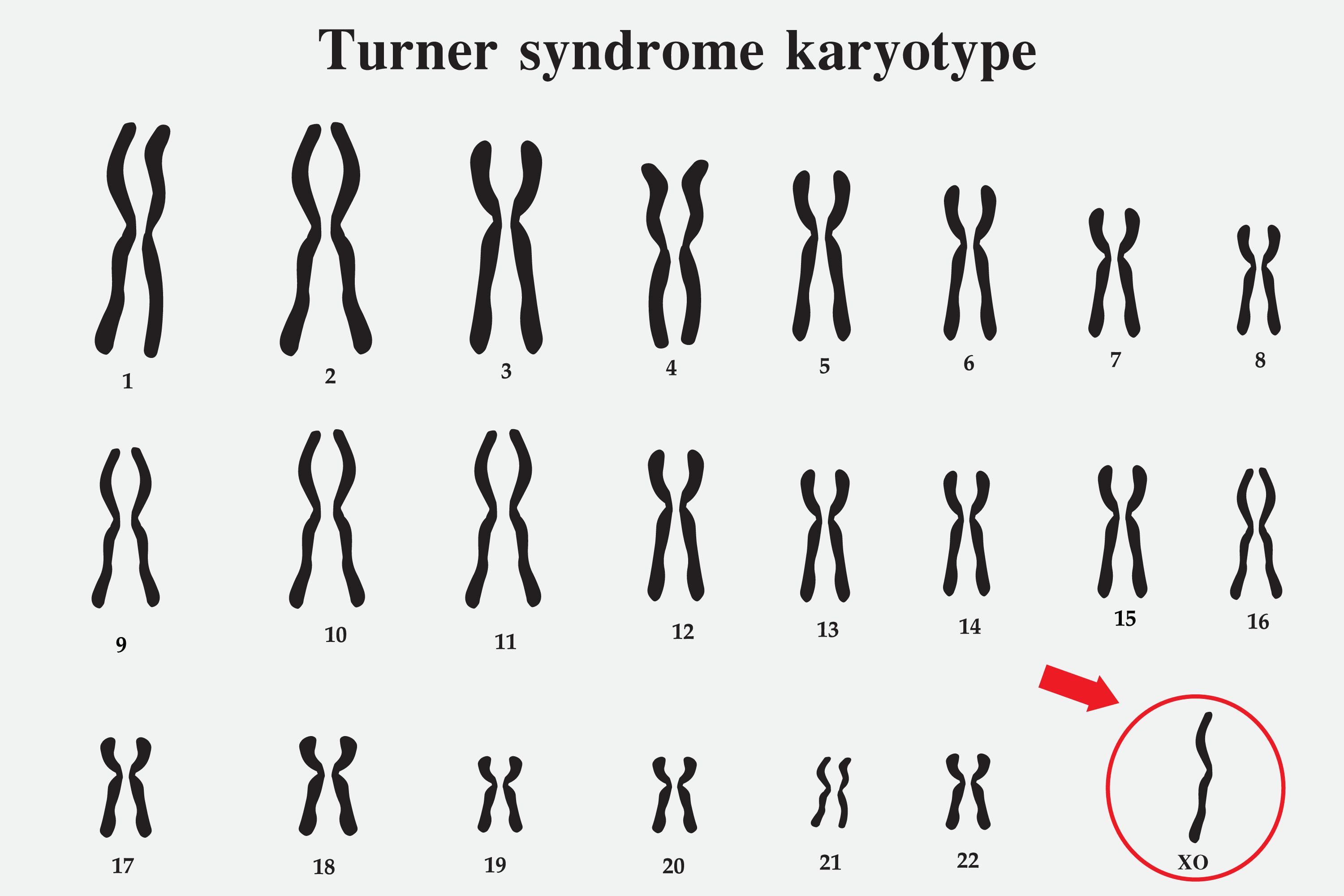 <p>Turner Syndrome Karyotype</p>