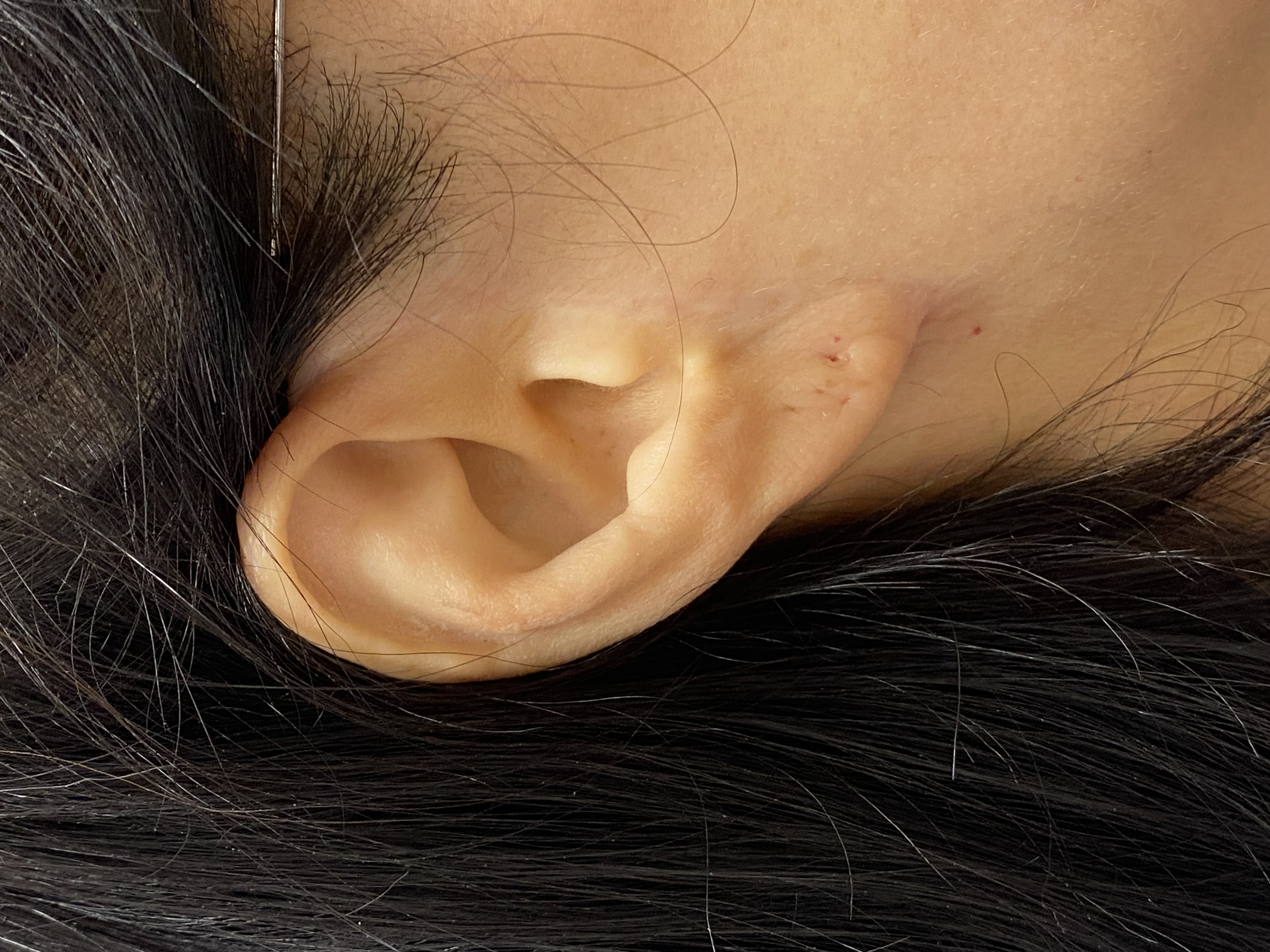 <p>Pixie Ear Deformity
