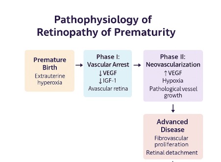 <p>Pathophysiology of Retinopathy of Prematurity