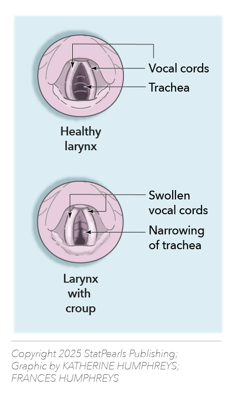 <p>Croup: Narrowing of the Upper Airway.</p>