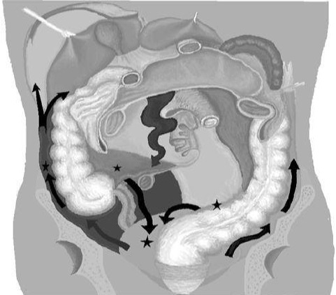 <p>Pathways of Peritoneal Fluid Movement