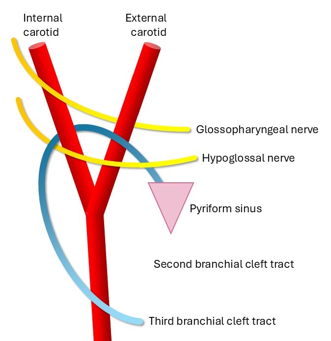 <p>Schematic of the Third Branchial Cleft Tract