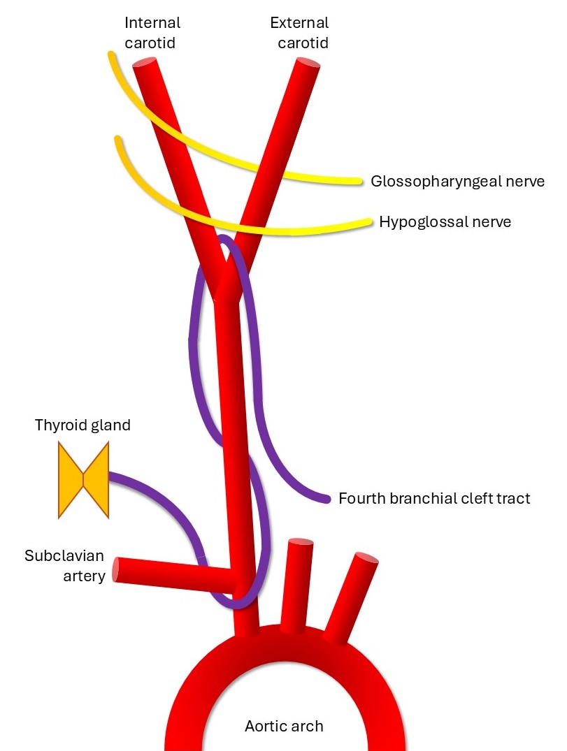 <p>Schematic of the Fourth Branchial Cleft Tract