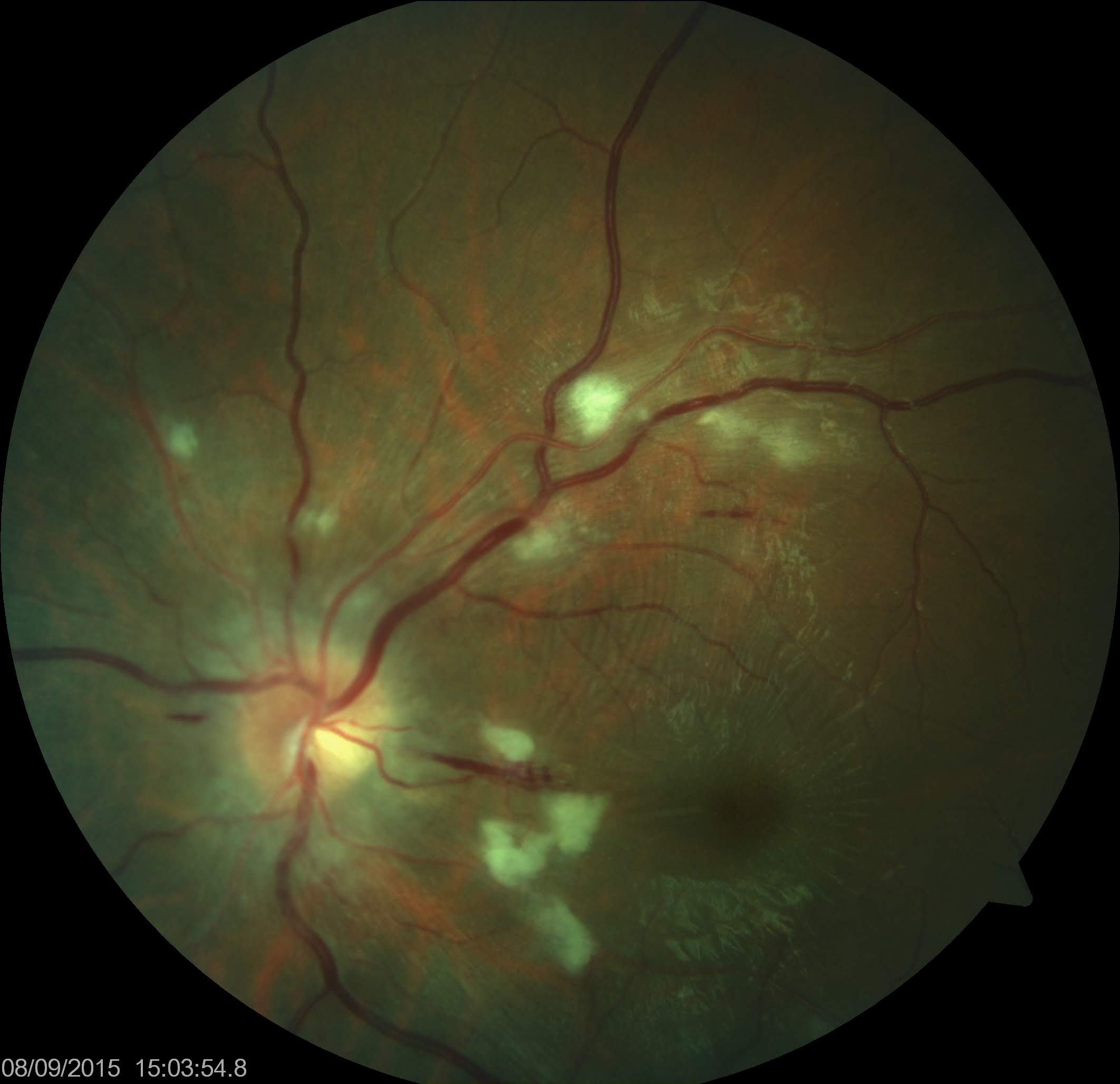 <p>Malignant Hypertensive Retinopathy