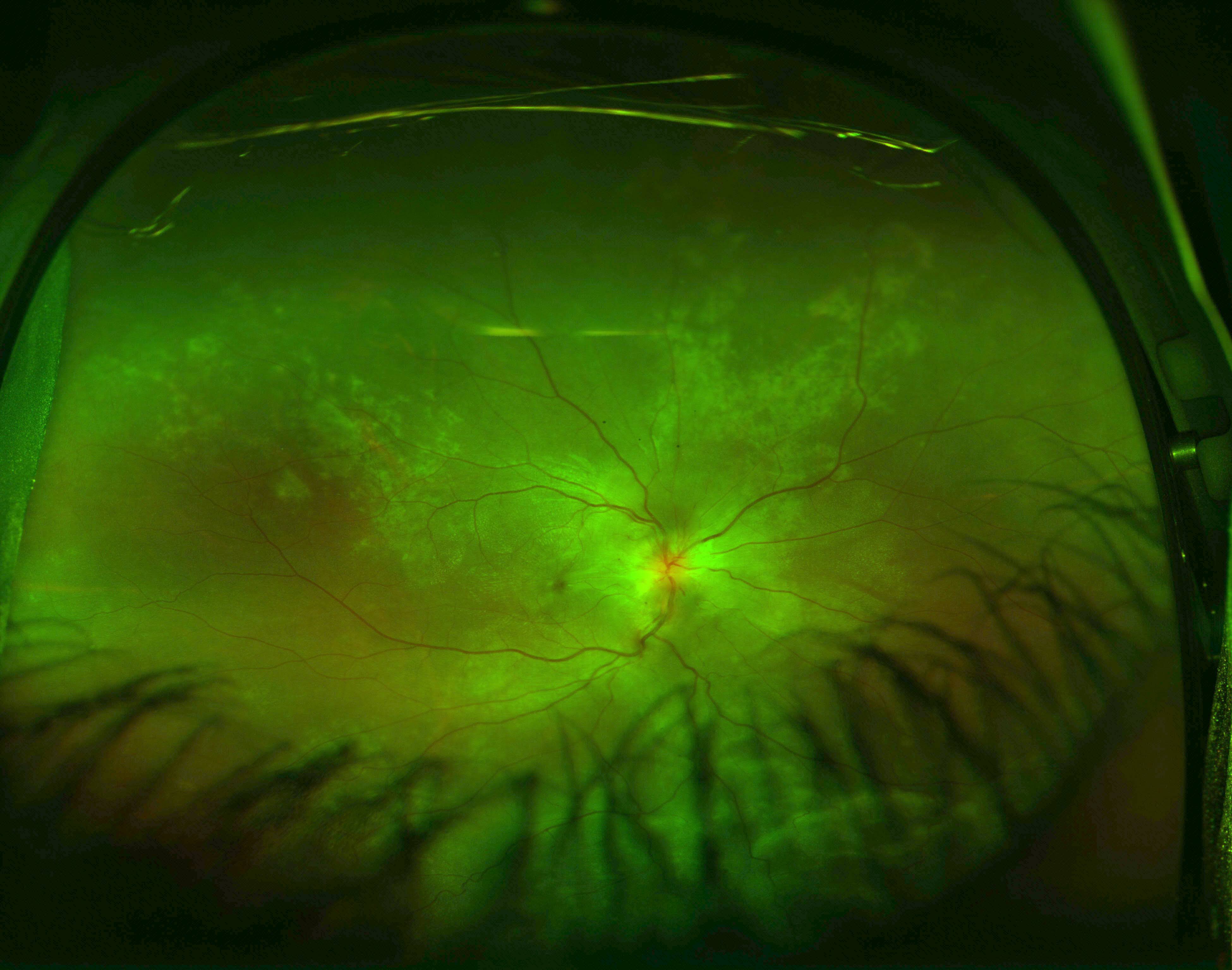 <p>Exudative Retinal Detachment and Elschnig Spots in Hypertensive Choroidopathy
