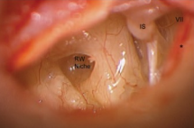 <p>Left Middle Ear Exposure
