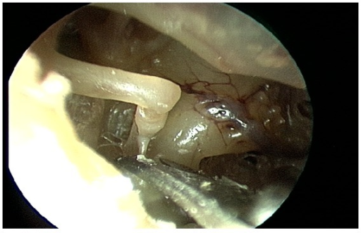 <p>Severing the Stapedius Tendon