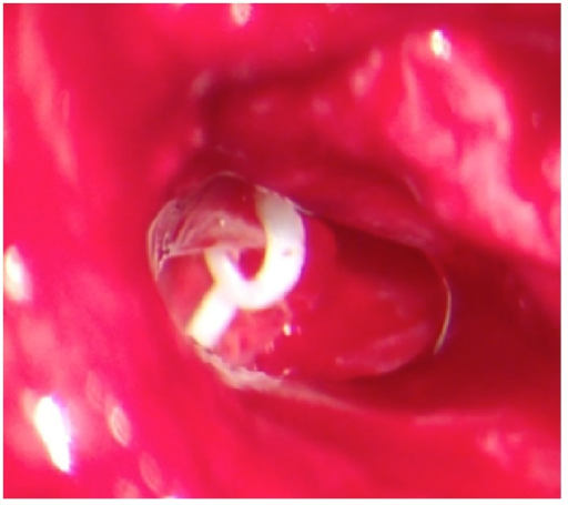 <p>Fluoroplastic Piston Placement