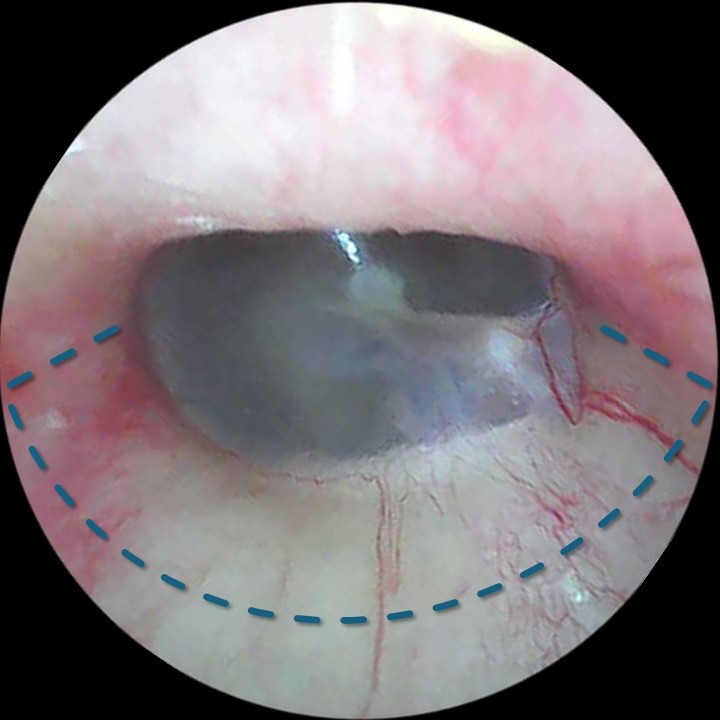 <p>Tympanomeatal Flap Incisions for Stapedotomy