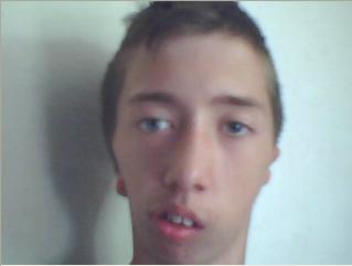 <p>Bilateral Hemifacial Microsomia