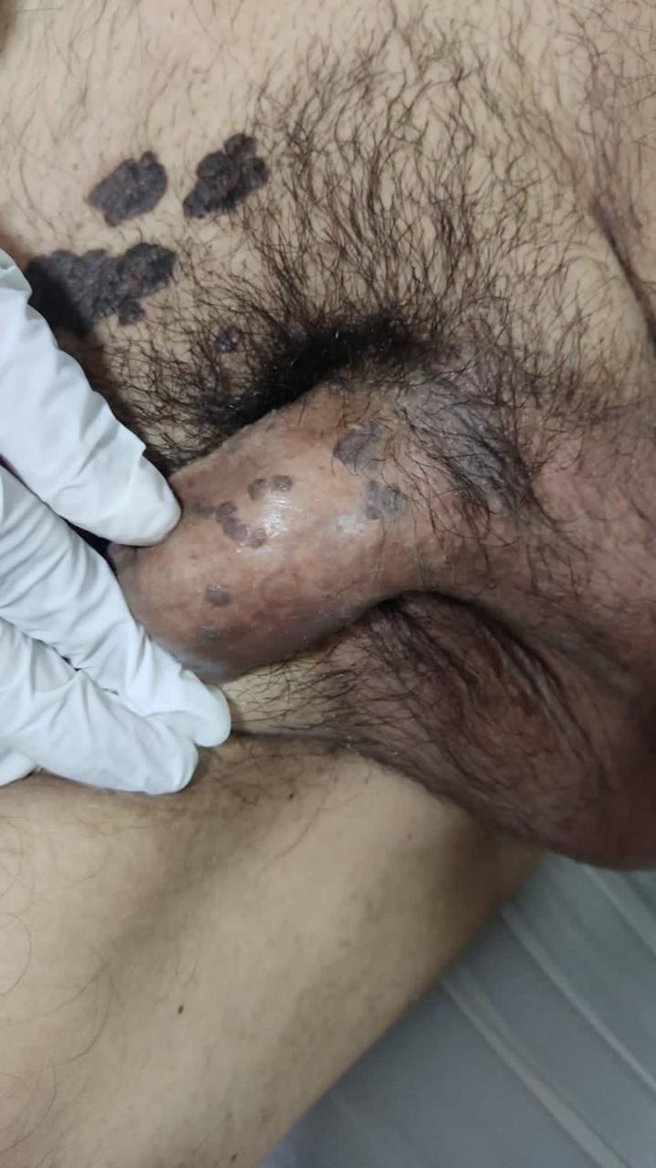 <p>Bowenoid Papulosis with Multifocal Involvement