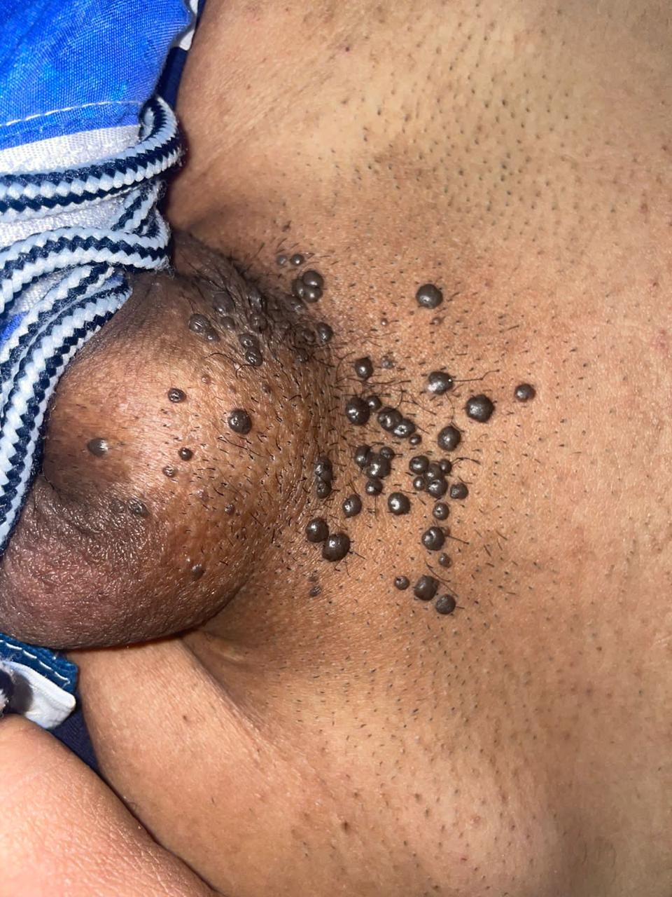 <p>Bowenoid Papulosis. Multiple shiny, confluent brown papules are present on the pelvis and base of the penis.</p>