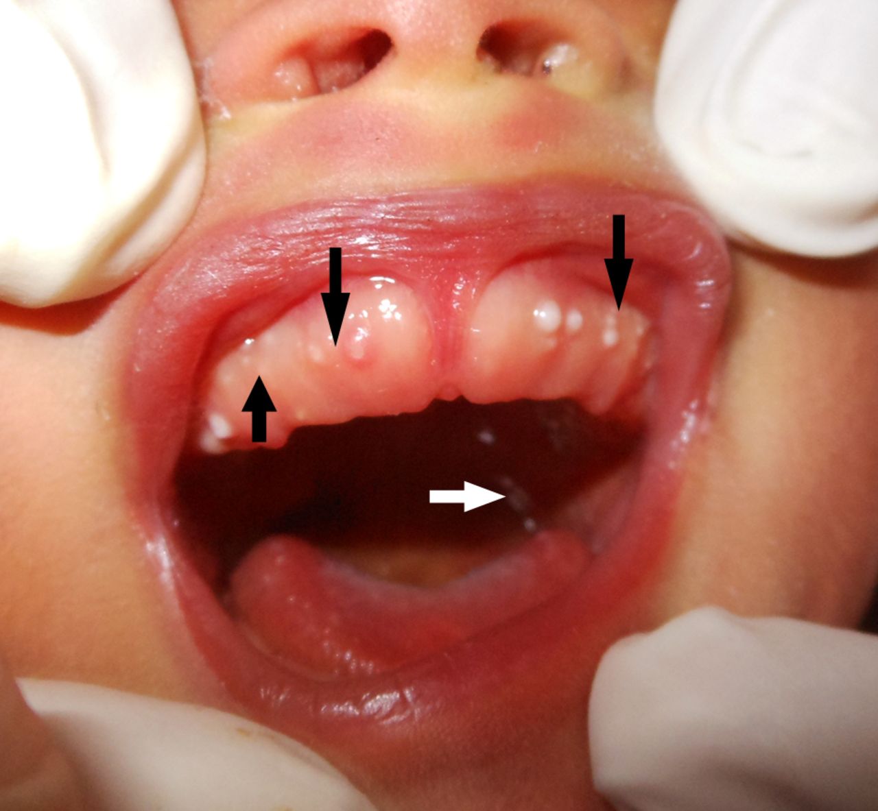 <p>Multiple Bohn Nodules on the Maxillary Alveolar Ridge.</p>