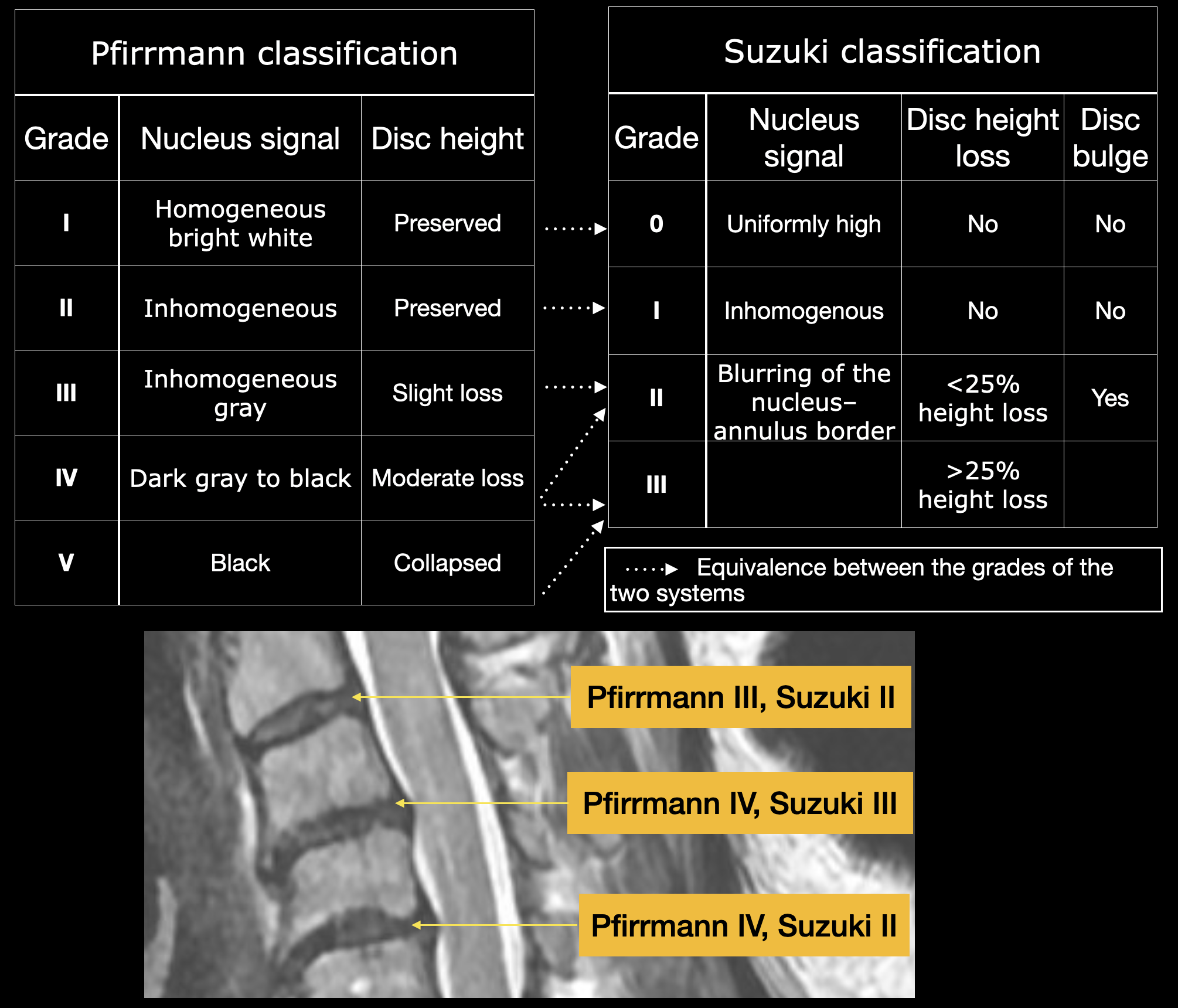 <p>Pfirrmann and Suzuki Classification, Cervical Disc Degenerative Disease