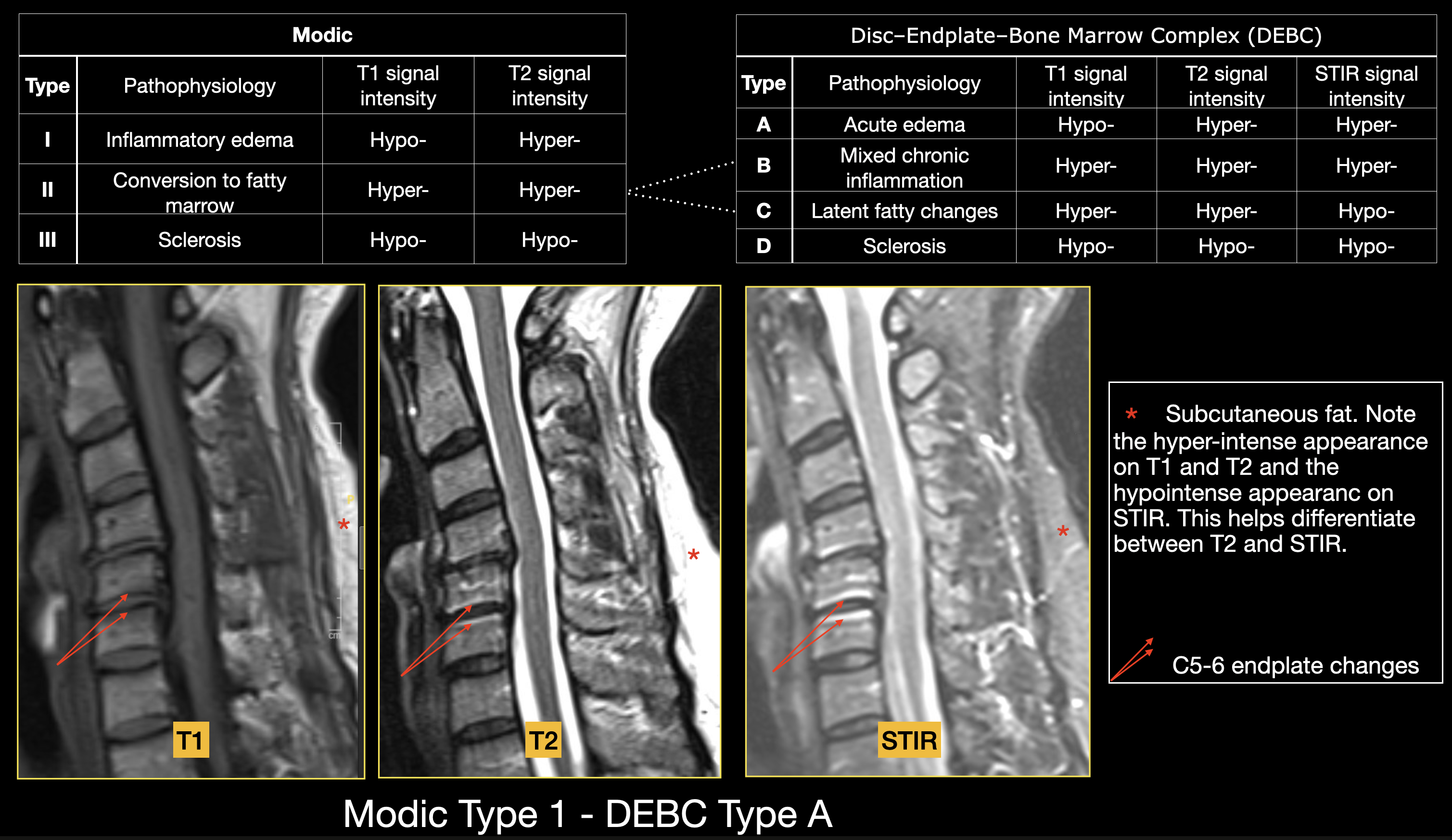 <p>Modic and Disc&ndash;Endplate&ndash;Bone Marrow Complex (DEBC) Classification Systems, Endplate Degenerative Changes