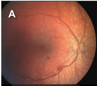 <p>Grade 1 Retinal Hemorrhage