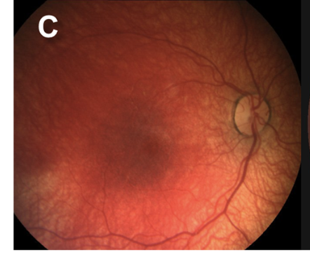 <p>Grade 3a Retinal Hemorrhage