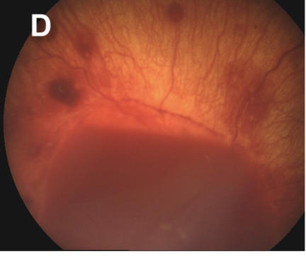 <p>Grade 3b Retinal Hemorrhage