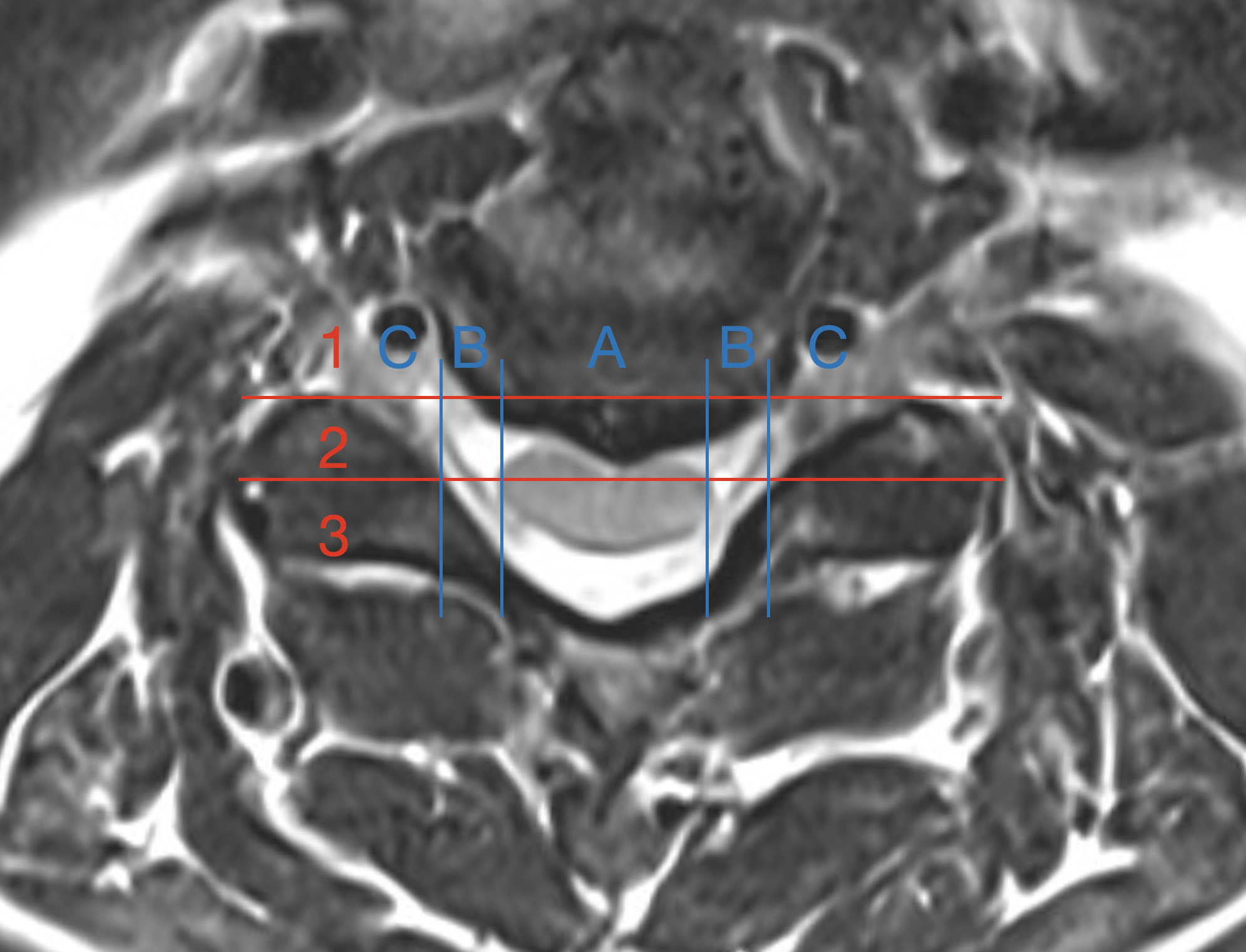 <p>Foramen Facet Spinal Disc Herniations, Magnetic Resonance Image