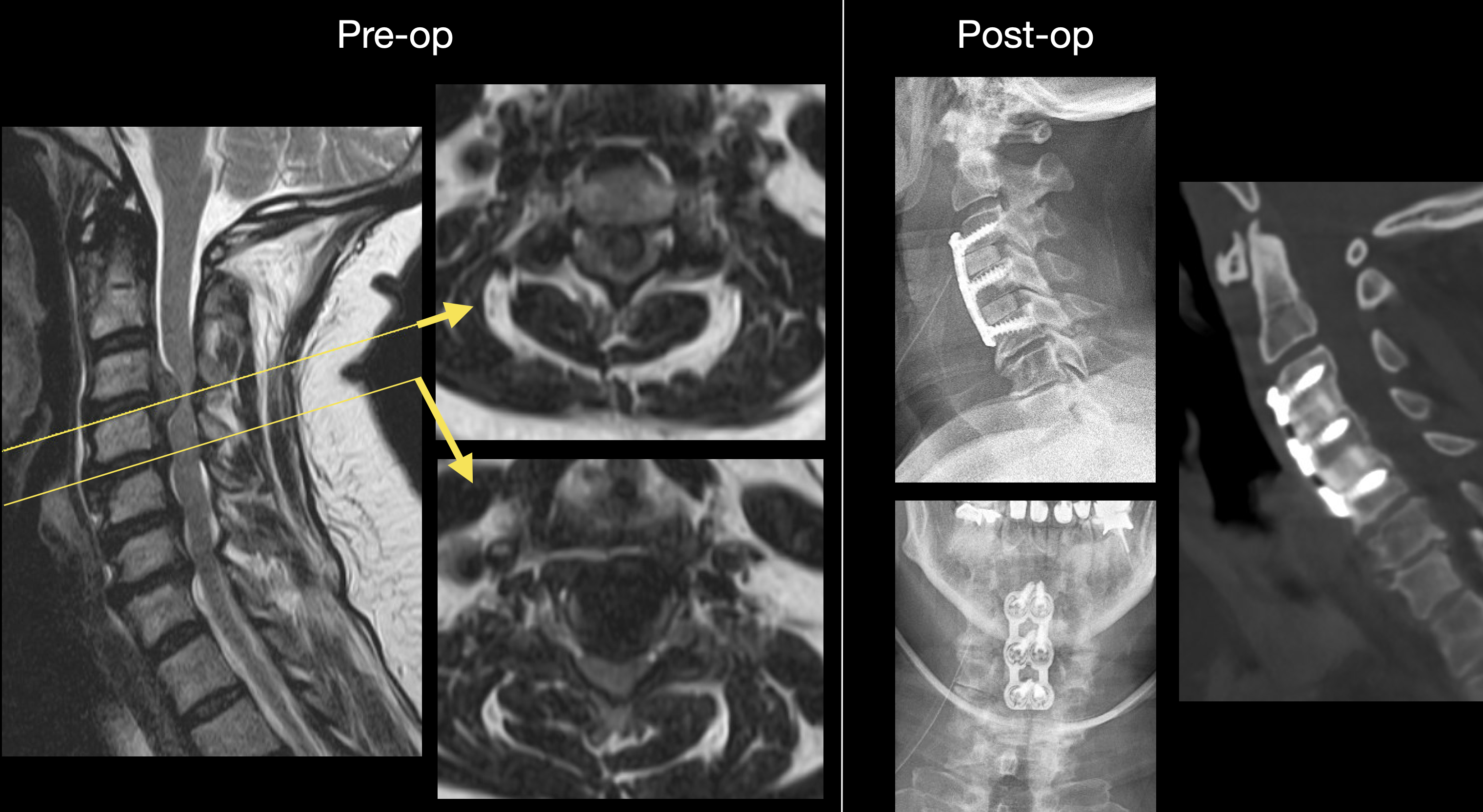 <p>Disc Herniations at C3&ndash;4 and C4&ndash;5, Magnetic Resonance Image