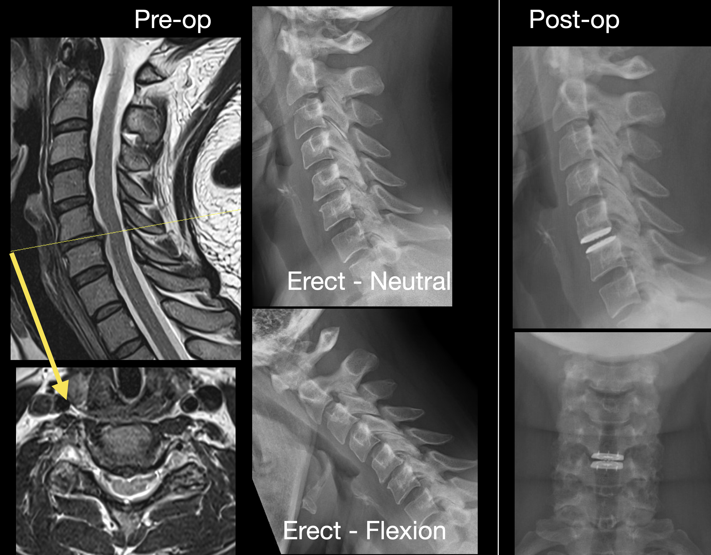 <p>C5&ndash;6 Central Disc Herniation, Magnetic Resonance Image