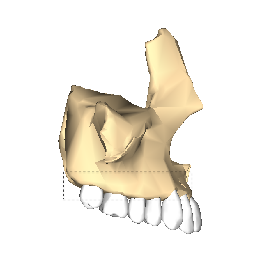 <p>Alveolar Process of the Maxilla