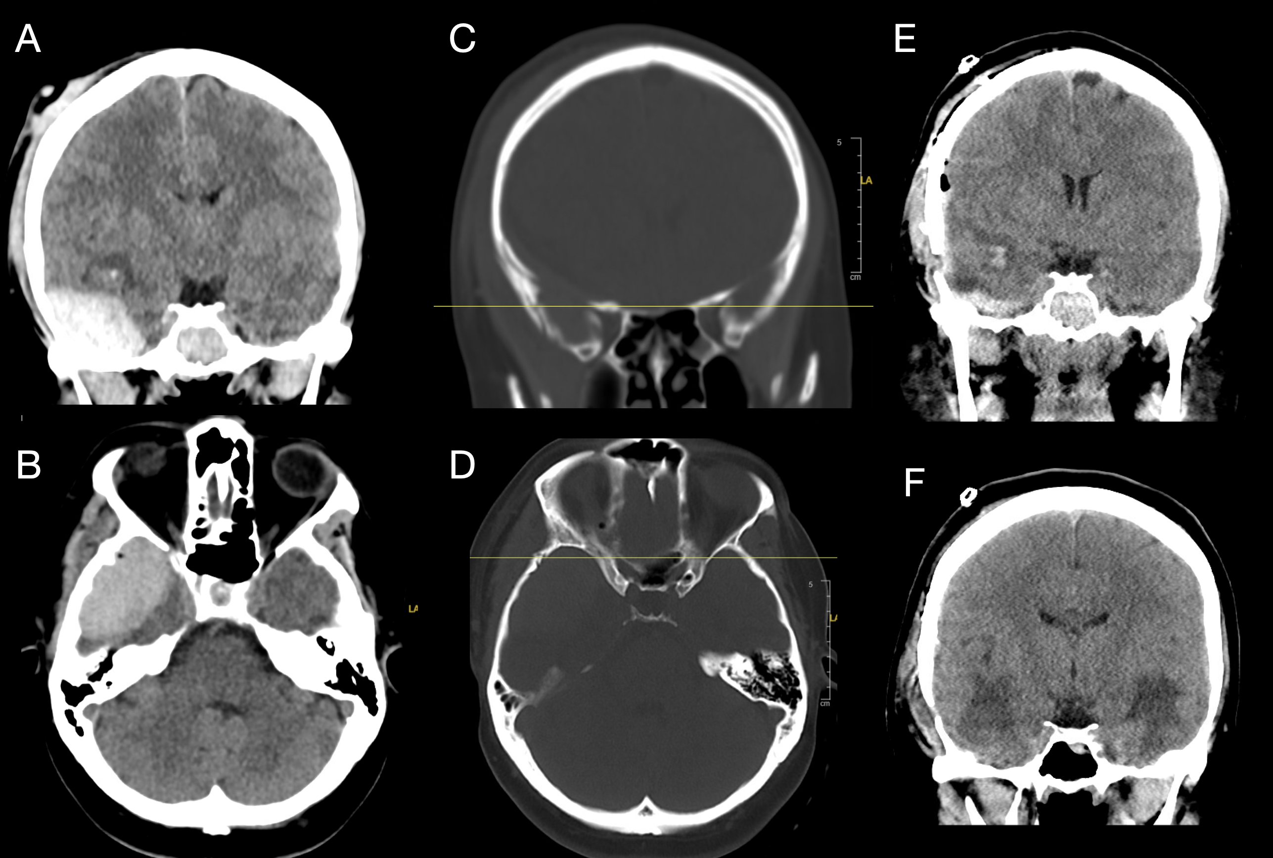 <p>Right Temporal Epidural Hematoma with Skull Fracture and Bilateral Contusions