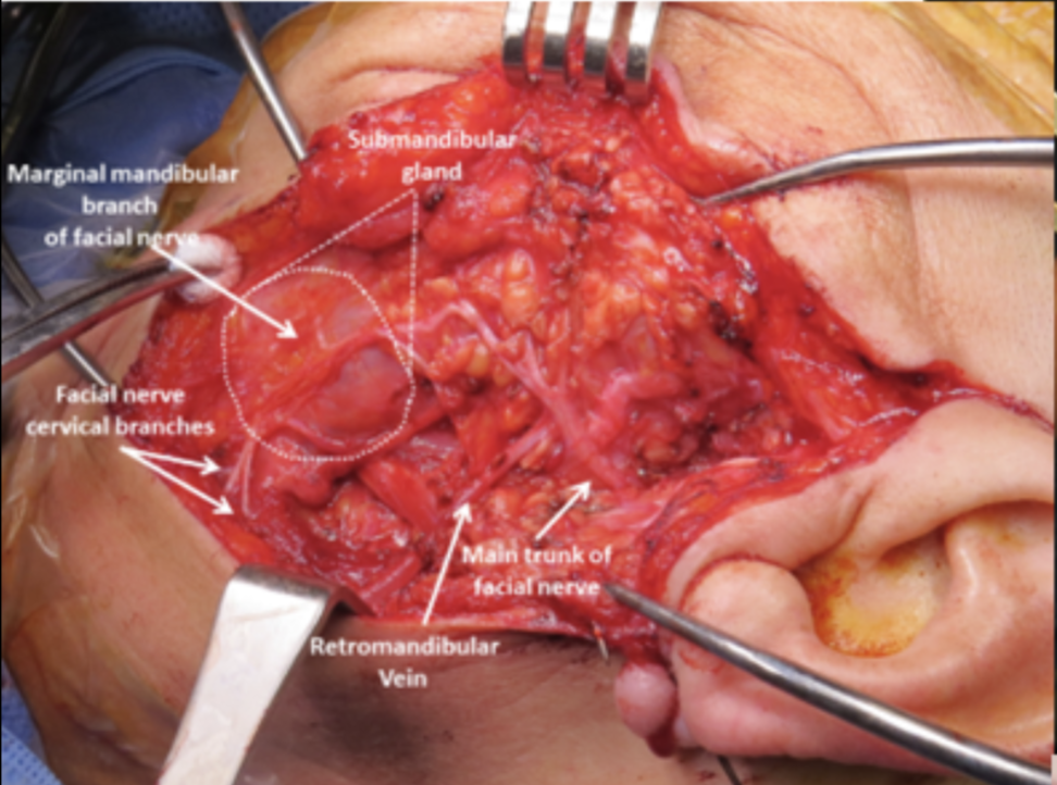 <p>Submandibular Gland Resection