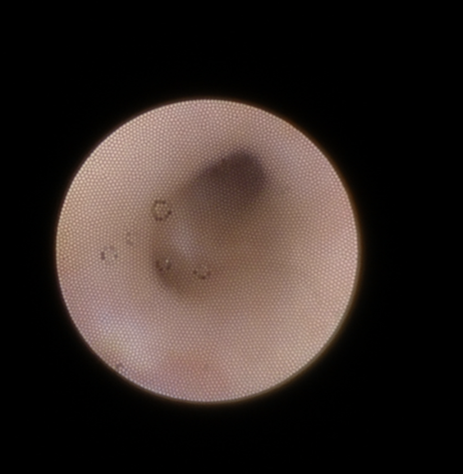 <p>Endoscopy View From Sialendoscopy