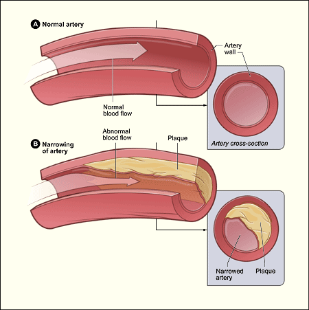 <p>Coronary Artery Disease