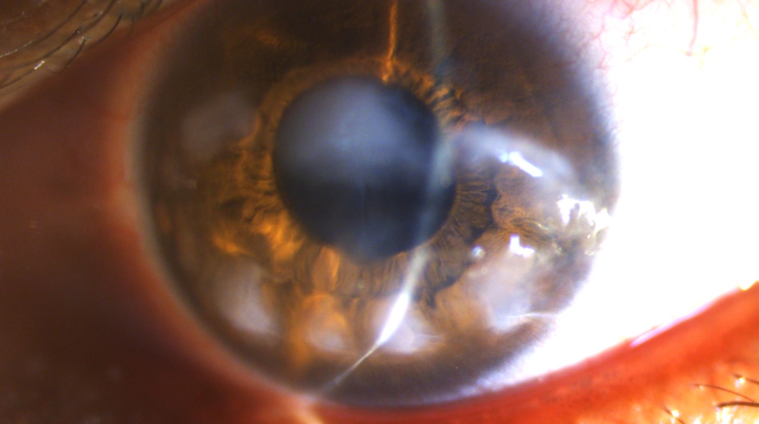 <p>Slit-Lamp Photograph of a Patient Suffering From Primary SNCD