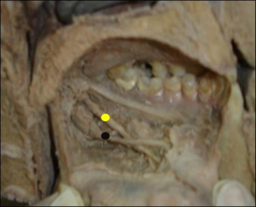 <p>Intersection of Lingual Nerve and Submandibular Duct