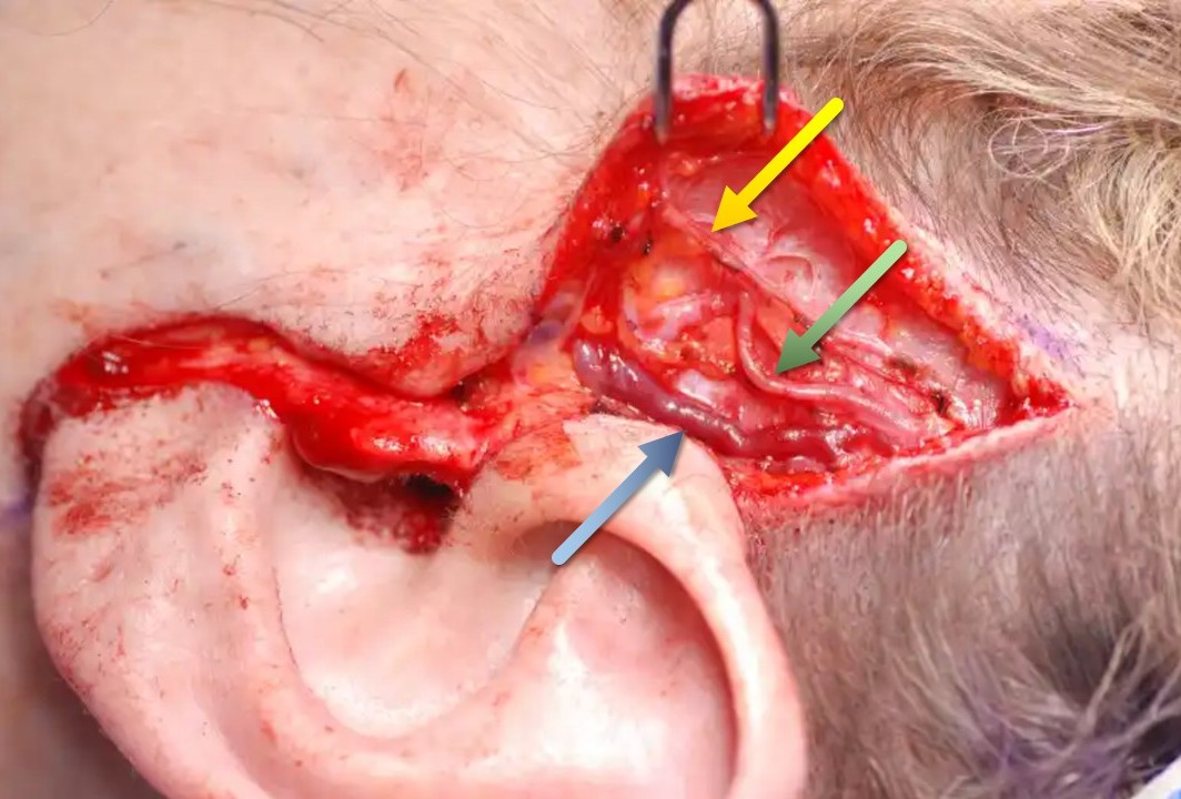 <p>Superficial Vessels and Nerves of the Temporal Region